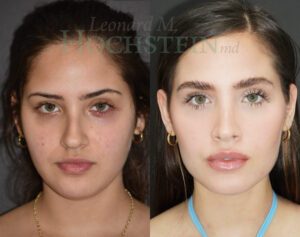 Rhinoplasty Patient