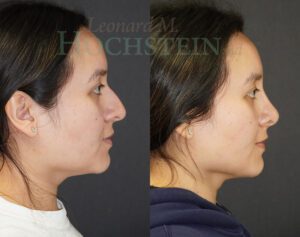 Rhinoplasty Patient 70