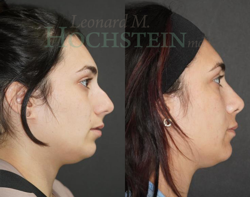 Rhinoplasty Patient
