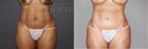 Tummy Tuck Patient