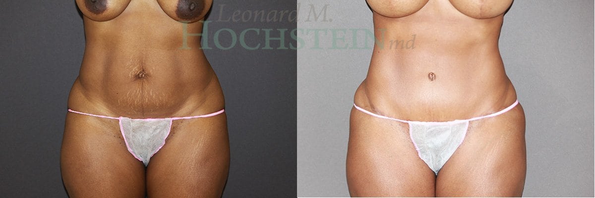 Tummy Tuck Patient