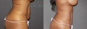 Tummy Tuck Patient