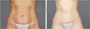 Tummy Tuck Patient