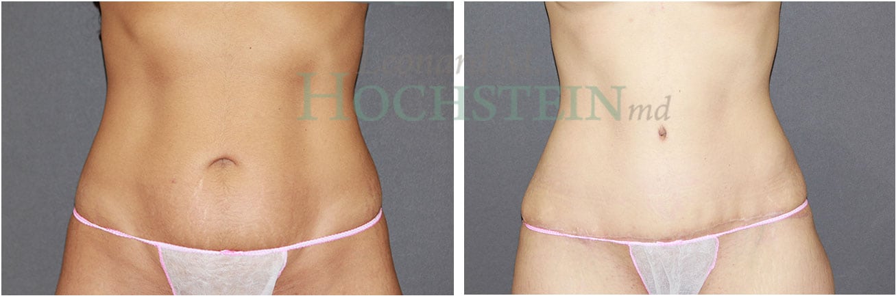 Tummy Tuck Patient