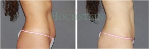 Tummy Tuck Patient