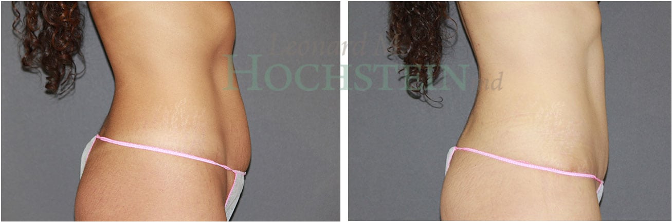 Tummy Tuck Patient