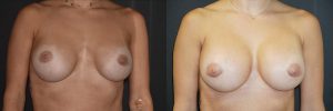 Breast Augmentation Patient