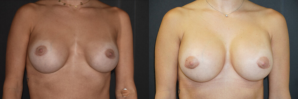 Breast Augmentation Patient