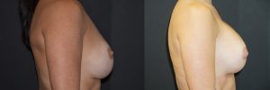 Breast Augmentation Patient