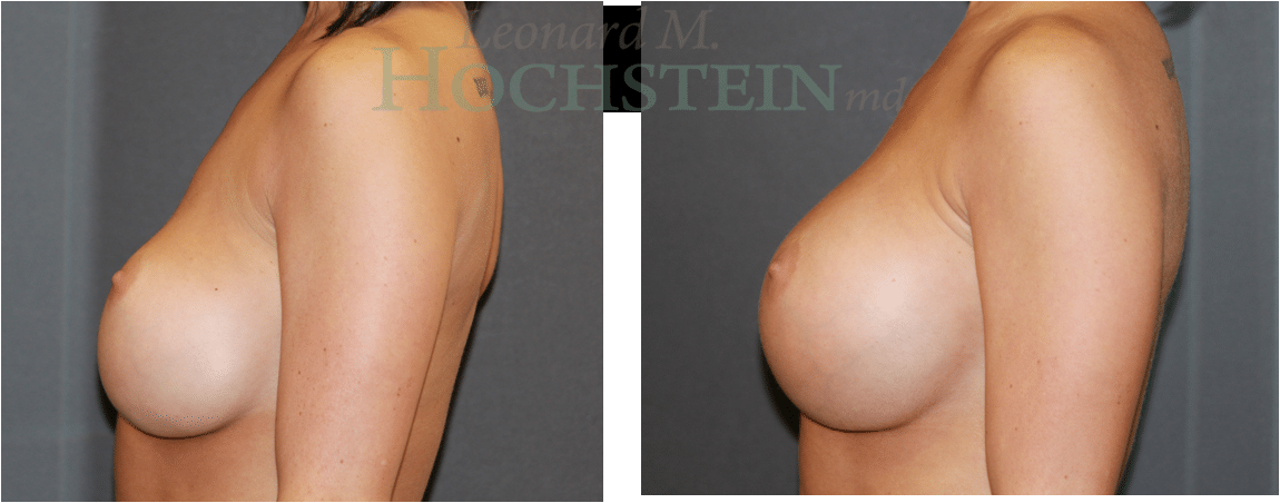 Breast Revision Patient