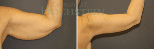Arm Lift Patient 02
