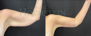 Arm Lift Patient