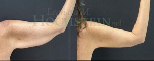 Arm Lift Patient 05