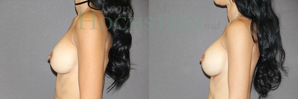 Breast Augmentation Patient