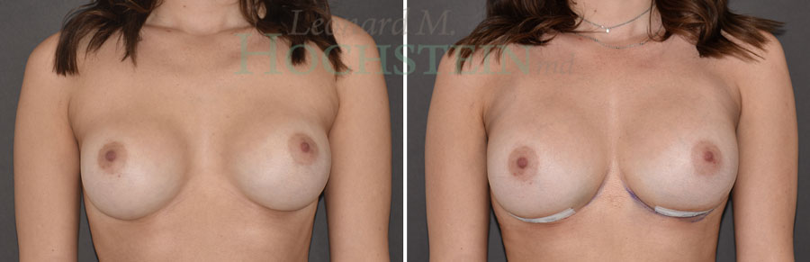 Breast Revision Patient