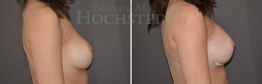 Breast Revision Patient