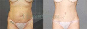 Tummy Tuck Patient