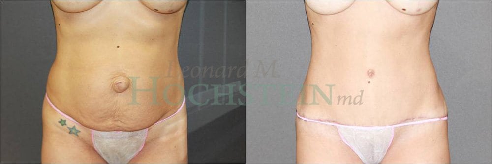 Tummy Tuck Patient