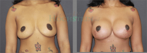 Breast Lift With Implants Patient