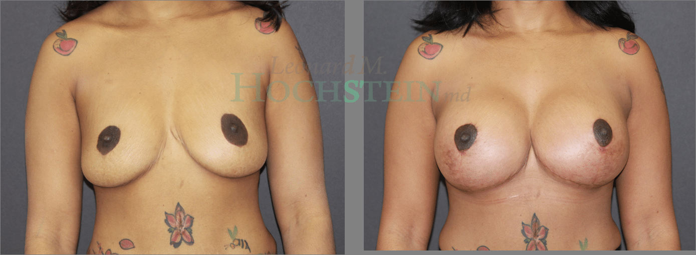Breast Lift With Implants Patient