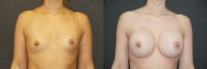 Breast Augmentation Patient