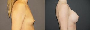 Breast Augmentation Patient