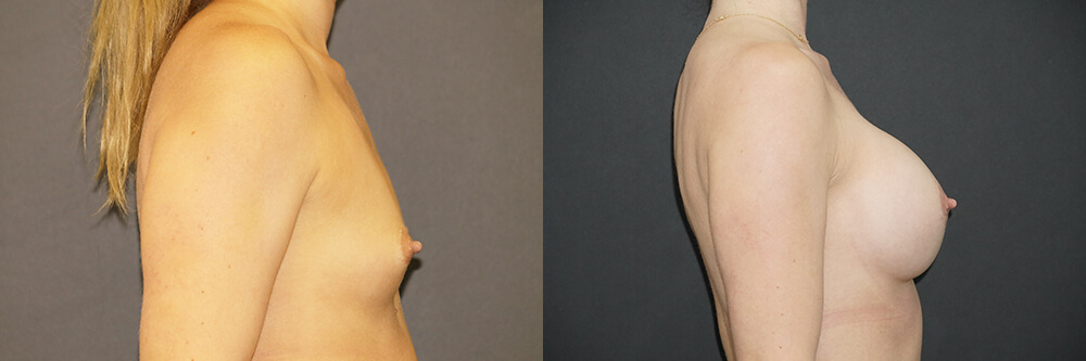 Breast Augmentation Patient