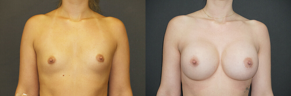 Breast Augmentation Patient