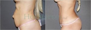 Tummy Tuck Patient