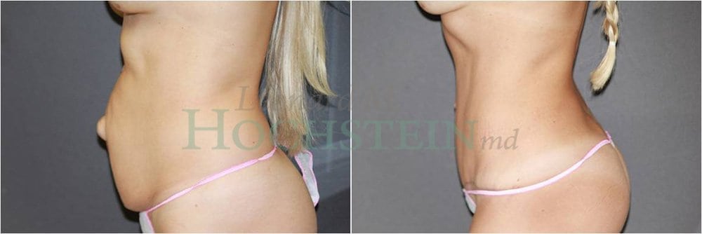 Tummy Tuck Patient