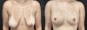 Breast Lift Patient 212