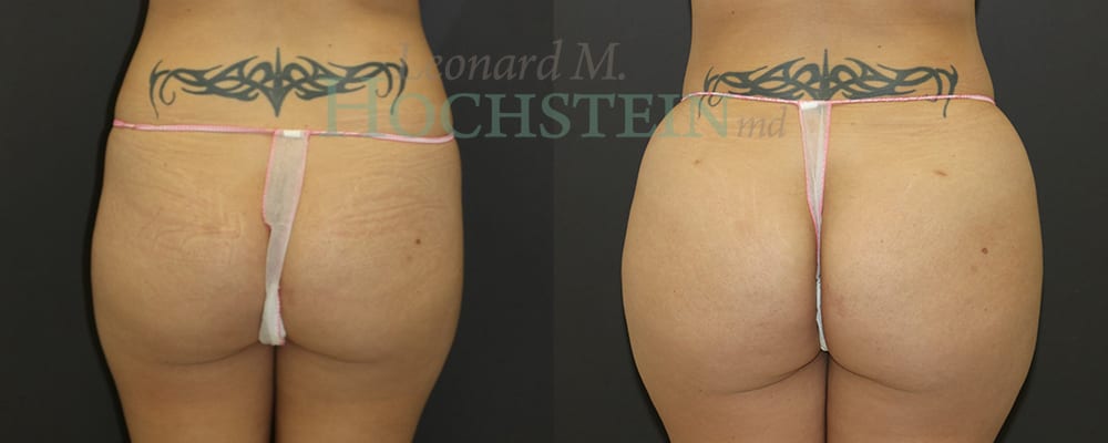 Brazilian Butt Lift Patient
