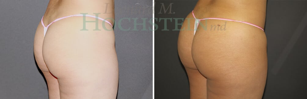Brazilian Butt Lift Patient