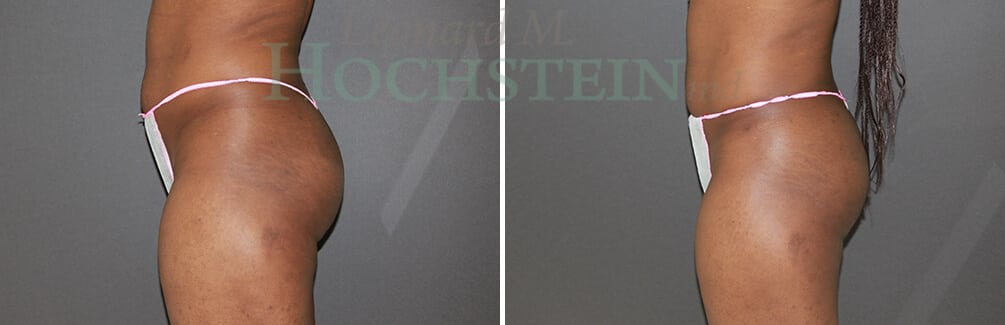 Brazilian Butt Lift Patient