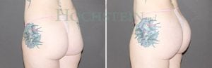 Brazilian Butt Lift Patient 05
