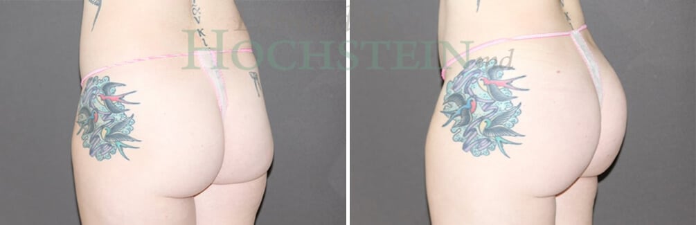 Brazilian Butt Lift Patient