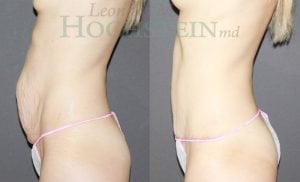 Mommy Makeover Patient