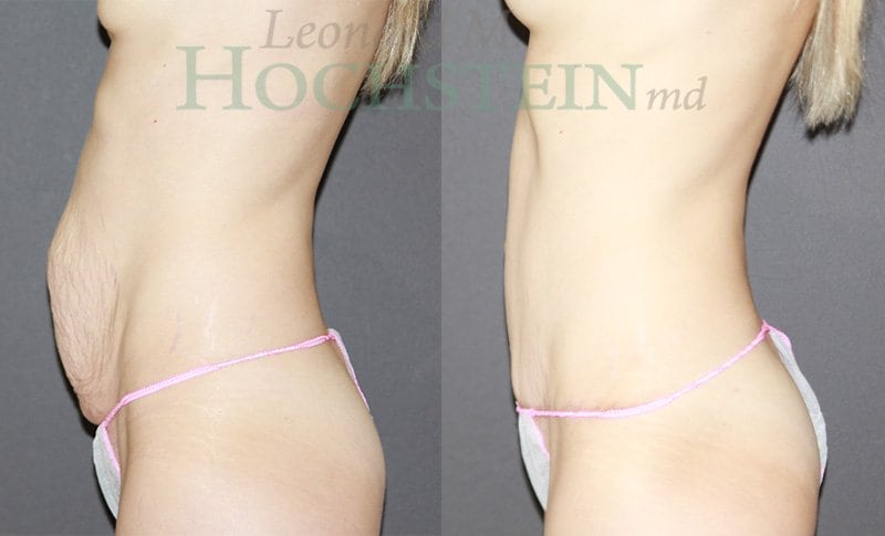 Mommy Makeover Patient