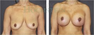 Breast Lift With Implants Patient