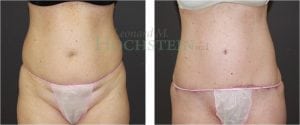 Tummy Tuck Patient 03
