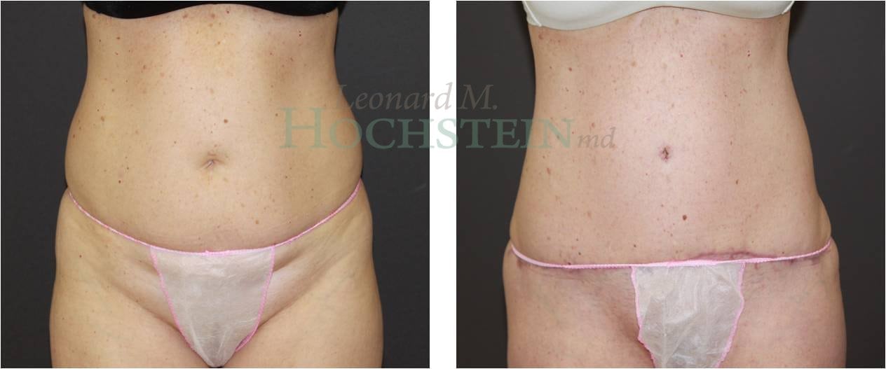 Tummy Tuck Patient
