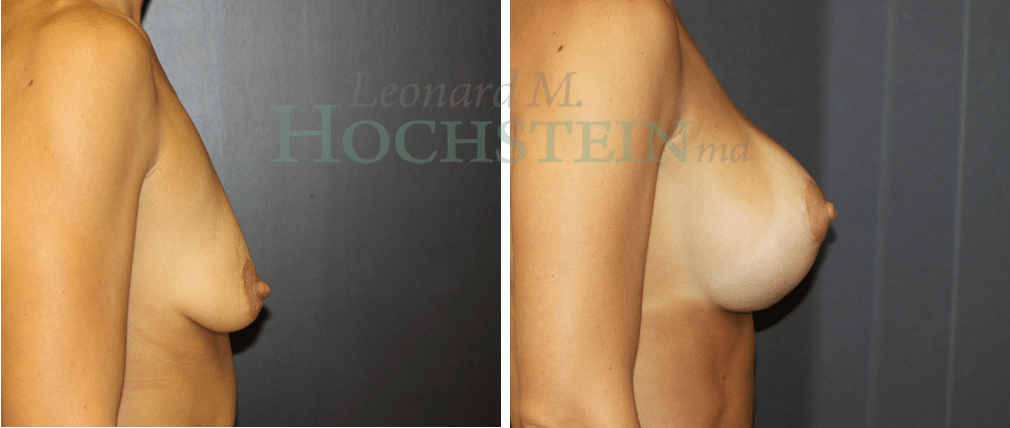 Breast Lift With Implants Patient