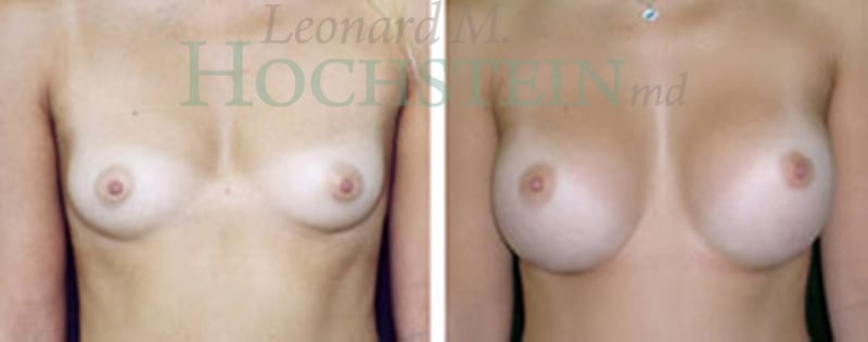 Breast Augmentation Patient