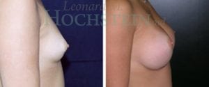 Breast Augmentation Patient