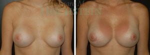 Breast Augmentation Patient