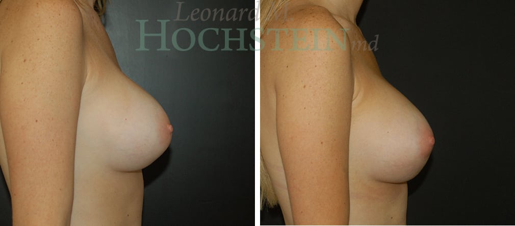 Breast Augmentation Patient