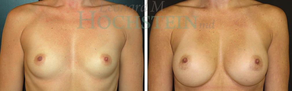 Breast Augmentation Patient
