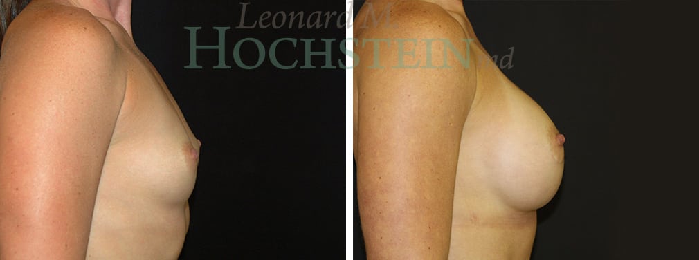 Breast Augmentation Patient