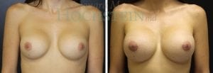 Breast Augmentation Patient