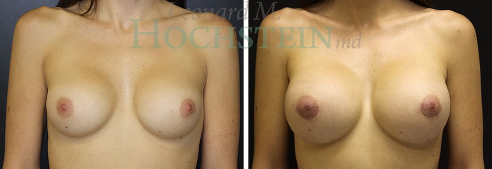 Breast Augmentation Patient
